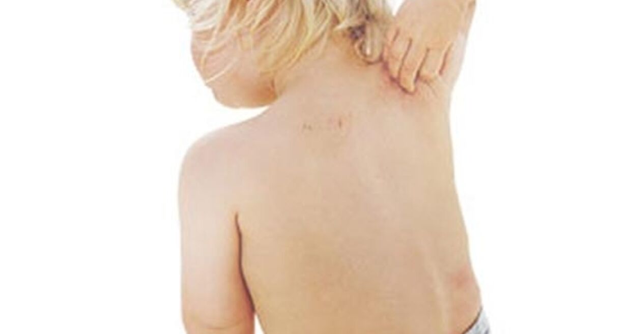 Eczema e o bebé