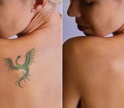 Fez uma tatuagem e arrependeu-se?