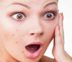 O seu filho tem Acne? Se calhar anda stressado... 