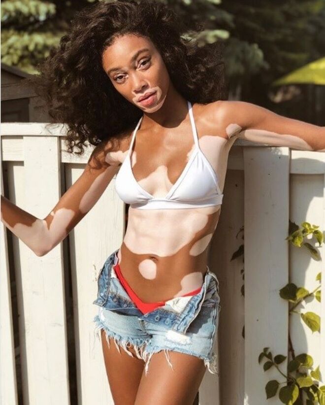 Winnie Harlow