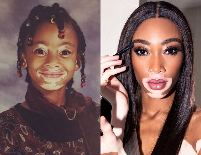 Winnie Harlow