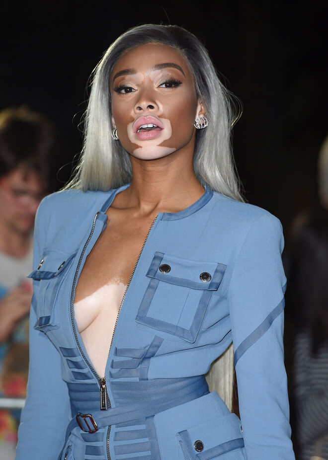 A modelo Winnie Harlow