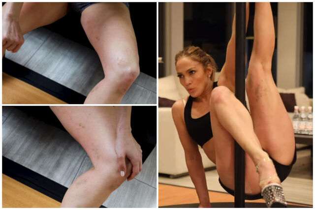 Jennifer Lopez exibe nódoas negras