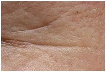 Semana 0 (antes)****