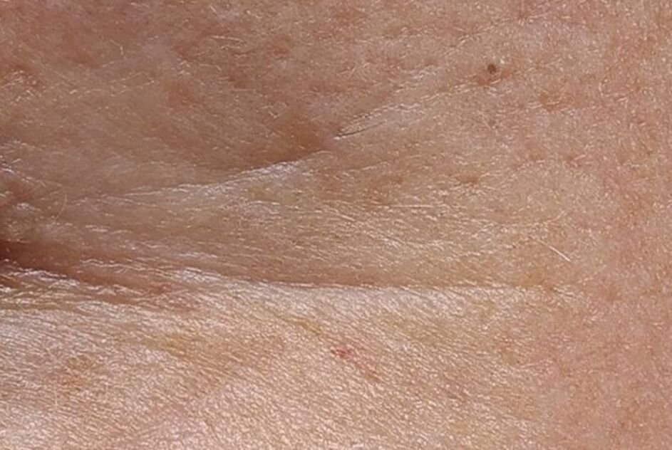 Semana 4 (depois)****