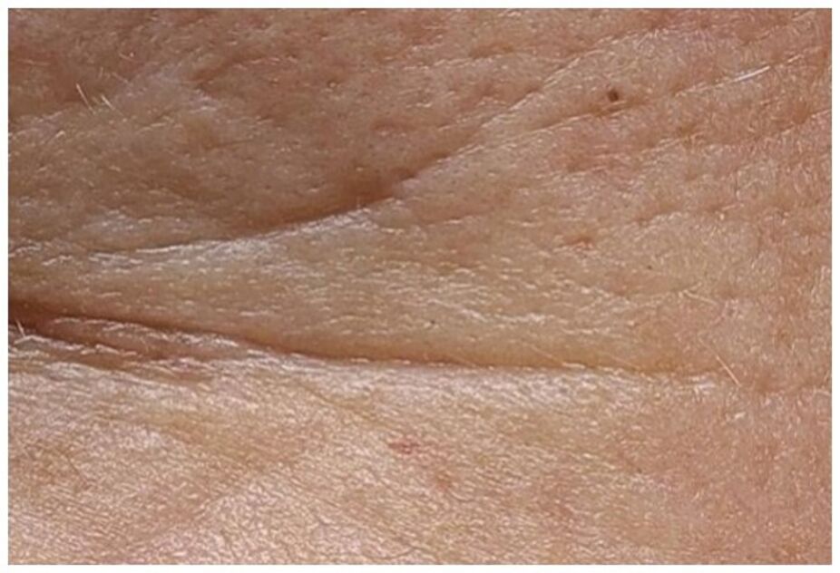 Semana 0 (antes)****