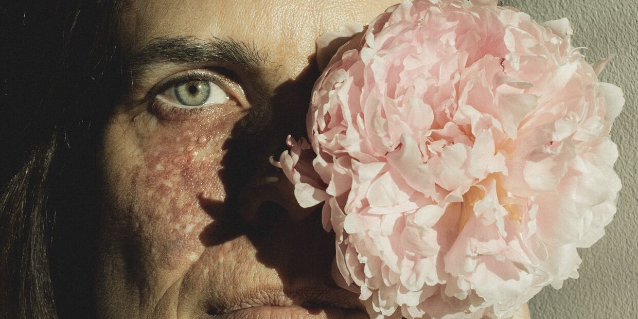 Raquel Luís fala de autoestima e da marca de nascença no rosto