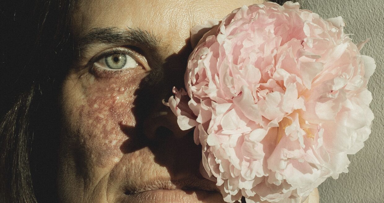 Raquel Luís fala de autoestima e da marca de nascença no rosto