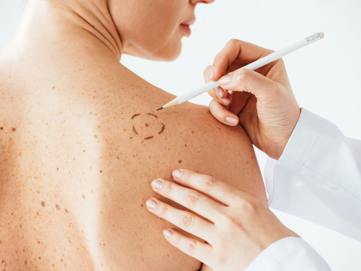 Campanha Euromelanoma alerta para sinais de cancro da pele e a importância do diagnóstico precoce.
