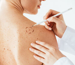 Campanha Euromelanoma alerta para sinais de cancro da pele e a importância do diagnóstico precoce.
