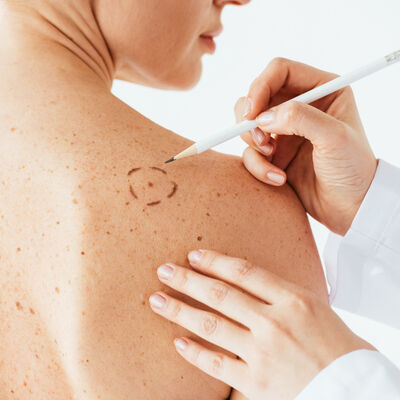 Campanha Euromelanoma alerta para sinais de cancro da pele e a importância do diagnóstico precoce.
