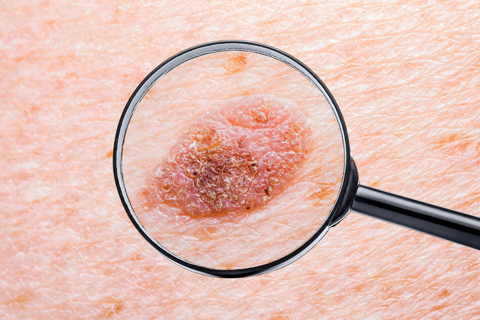 Campanha Euromelanoma alerta para sinais de cancro da pele e a importância do diagnóstico precoce.
